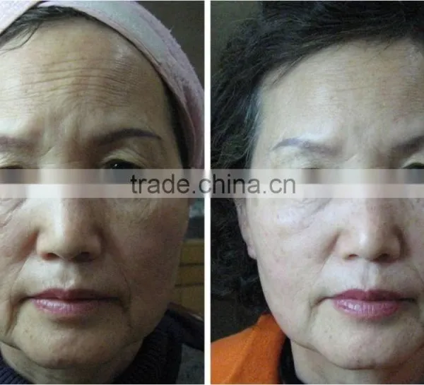 Low Price 3 Head Pieces Hifu Face Machine Anti-aging Machine photo-2