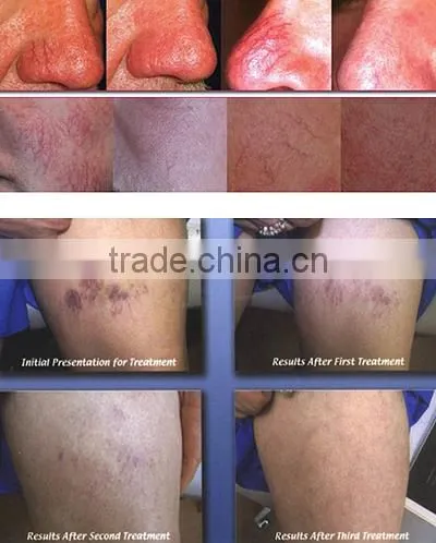 2016 Professional Mini High Frequency Spider Vein Removal/ Vascular Removal/thread Vein Removal photo-6