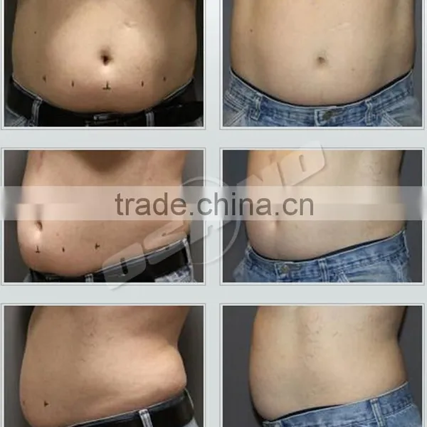 Protable 3 In1 Best Fat Reduce Slimming Lipo Laser and Cryolipolisis Criolipolisis photo-6