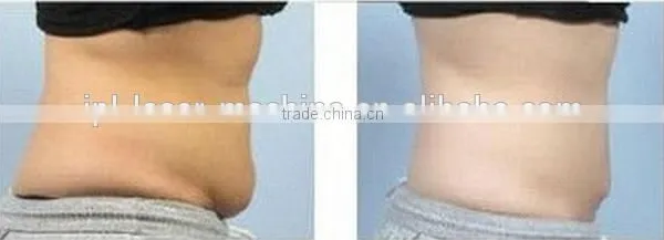Cavitation Lipo Machine 2015 Hot Ultrasonic Cavitation RF Machine/ Home Portable Body Contouring Face Lifting Body Fat Reduction Ultrasound RF System photo-4