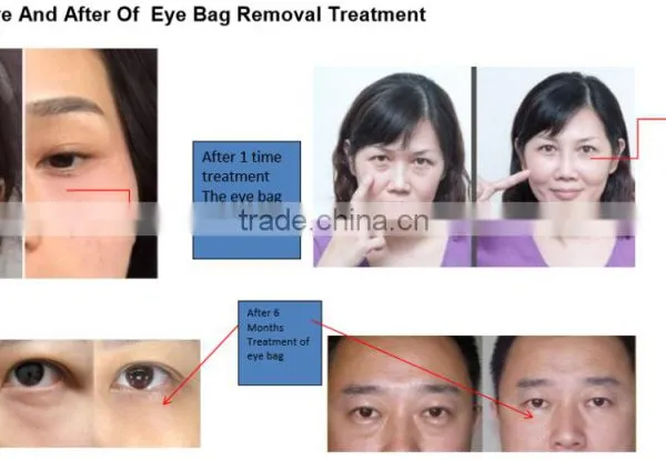 Beauty Machine Eye Care System for Eye Bag Removal for Wrinkle Removal photo-4