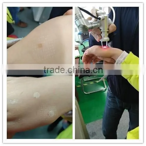 USA rf Tube Co2 Fractional Medical Laser Therapy for Scar Removal, Vaginal Tightening photo-6