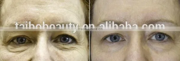 2016 Fractrional rf Macro Needling Machine Skin Rejuvenation Wrinkle Removal Face Lift Beauty Salon Spa Equipment Supplier photo-6