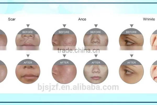 Carboxytherapy F5 Co2 RF/Glass Pipe Fractional Vagina Vascular Treatment Tightening Co2 Laser Equipment Anybeauty Original Manufacturer 10MHz photo-6