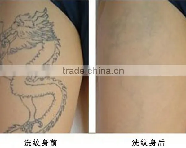 Laser Removal Tattoo Machine 2015 Professional Q-switch Nd Yag Laser 0.5HZ Tattoo Removal Machine Naevus Of Ito Removal photo-6