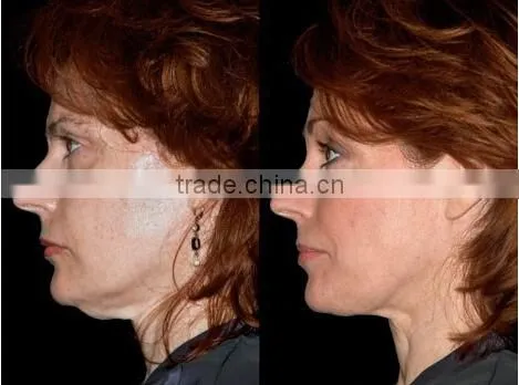 Monopolar Radio Frequency RF Skin/Beauty Salon Equipment RF & Us photo-6