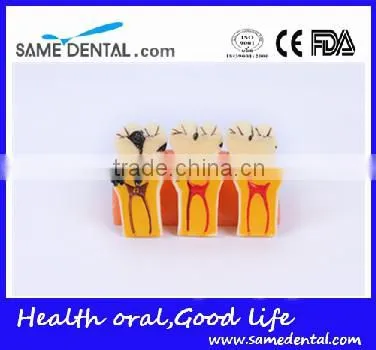 4 Times the Cavities Progress Model Dental Eduction Assitant No. DEA-16 photo-4