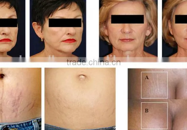 2016 Multipolar rf Ultrasonic Liposuction Cavitation Machine for Sale photo-6