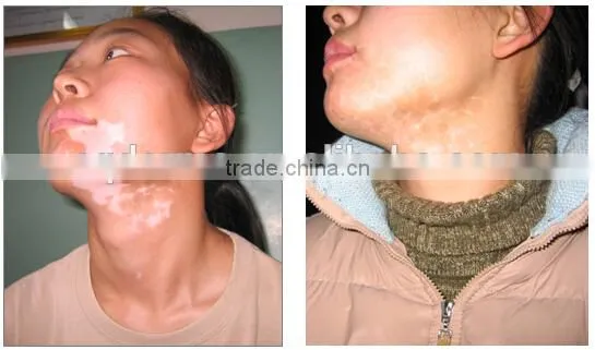 Hand Held NB UVB Phototherapy 311nm Lamp for Vitiligo Eczema Psoriasis