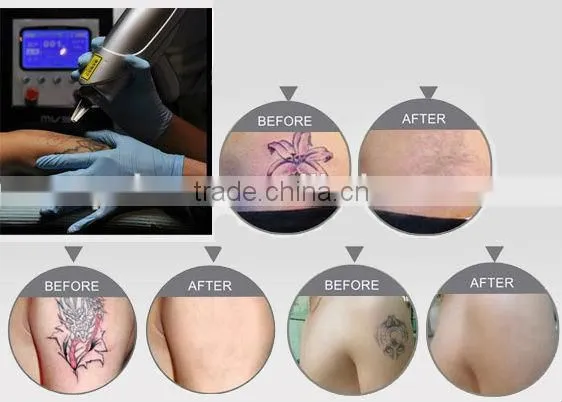 Facial Veins Treatment Low Price Q-Switched Nd:YAG Laser Tatoo Removal Machine By QTS Naevus Of Ito Removal photo-4