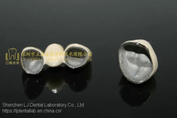 Dental Crown Porcelain Fused Metal, PFM, VMK, Dental Prostheses, Laboratoire Dentaire, Dentallabor, Laboratorio Dental, Dental Laboratory, Shenzhen LJ Dental Lab China photo-4