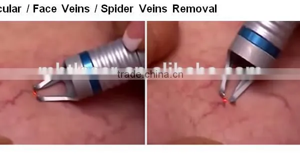 NEW 2016!!! 980nm Laser Spider Veins Removal Machine for Red Blood Silk Removal,angeioma Removal photo-5