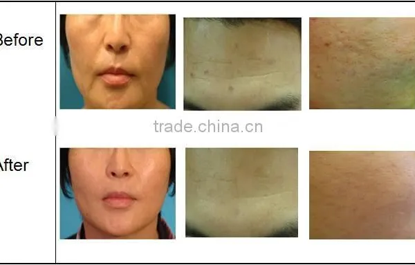 Distributor Wanted Portable rf Fractional Micro Needle Machine/fractional rf Micro Needle Device photo-4