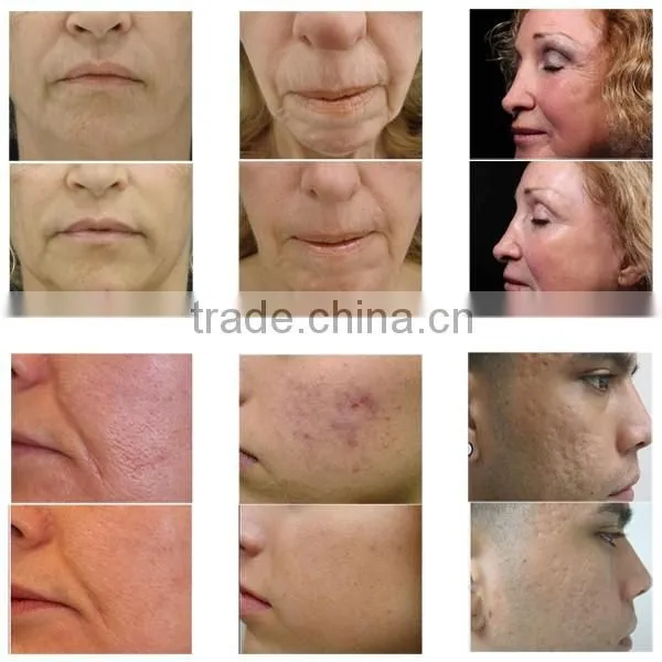 Professional Medical Clinic Home Use Best Fractional RF Micro Needle Wrinkle / Acne Scar Removal/ Skin Tightening Facial Machine photo-2