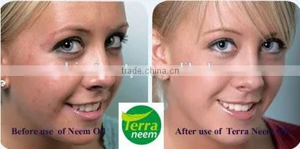PURE NATURAL - Essential Neem Oil photo-4