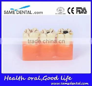 4 Times the Cavities Progress Model Dental Eduction Assitant No. DEA-16 photo-2