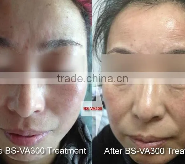 High Frequency Vascular Removal Red Spider photo-5