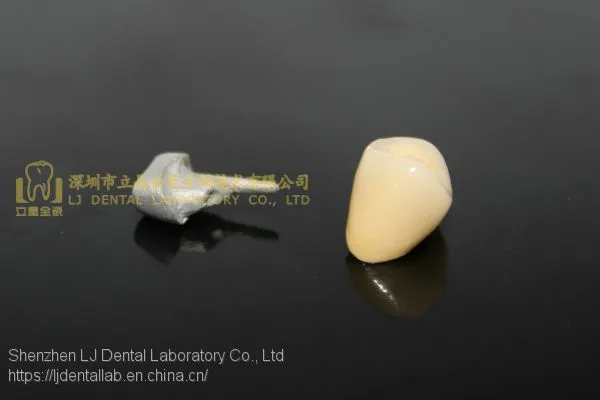 Dental Crown Porcelain Fused Metal, PFM, VMK, Dental Prostheses, Laboratoire Dentaire, Dentallabor, Laboratorio Dental, Dental Laboratory, Shenzhen LJ Dental Lab China photo-5