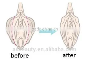 Warts Removal Medical Co2 Fractional Laser Machine/Vaginal 10600nm Carboxytherapy Tightening/ Vaginal Rejuvenation Machine Mole Removal photo-5