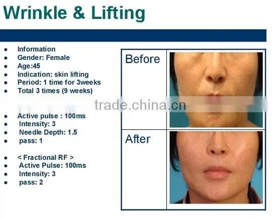 2016 Factory Machine Wholesale Radio Frequency Wrinkle Removal Face Lift Skin Rejuvenation and Acne Scar Clearance photo-4