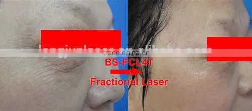 Professional Top Sell !! Laser Co2 Fractional Skin Resurfacing Machine Laser Skin Treatment Machine CE Wrinkle Removal photo-2