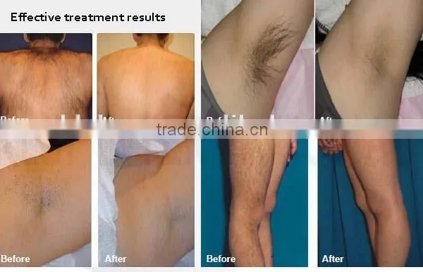 808nm Permanent Diode Laser Hair Removal Beauty Machine photo-4
