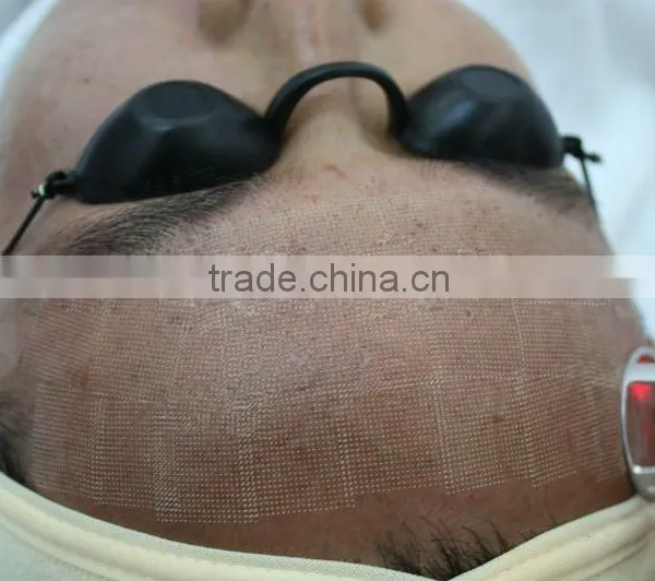 40W Fractional CO2 Laser Acne Scar & Wrinkle Removal / Co2 Laser Surgical Product Vaginal Applicator photo-2