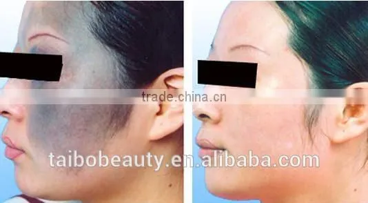 Varicose Veins Treatment 2017 New Design Vertical Q Switched Nd:yag Laser 1064&532nm For Pigmented Lesions Tattoo Removal Machine 532nm photo-6