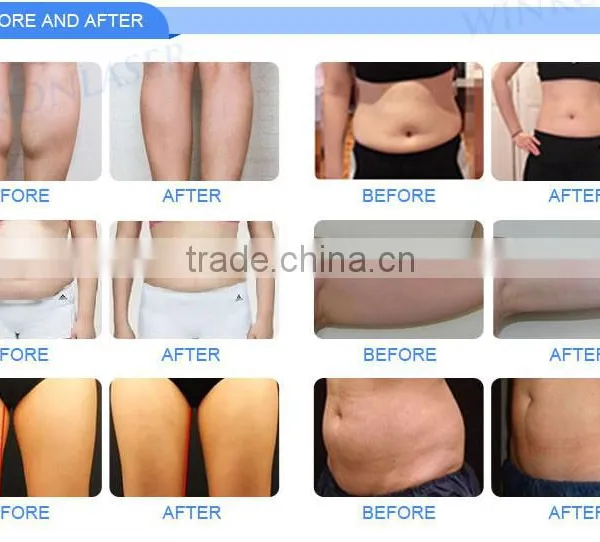 Fat Melting Cryolipolysis Machine For Sale / Vertical Chinese Factory Price Cryolipolysis For Salon Slimming Reshaping photo-5