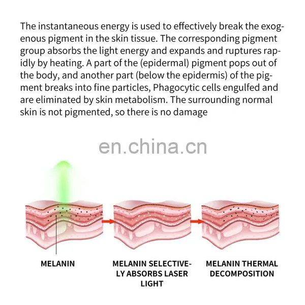 Portable Q-switch Laser Machine ND YAG Tattoo Removal Laser Machine Eyebrow Removal Pigmentation Carbon Peeling Machine photo-5