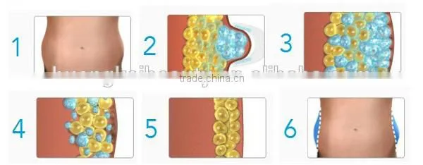 Most Popular Products Lipo Cryo Slimming Machine photo-4