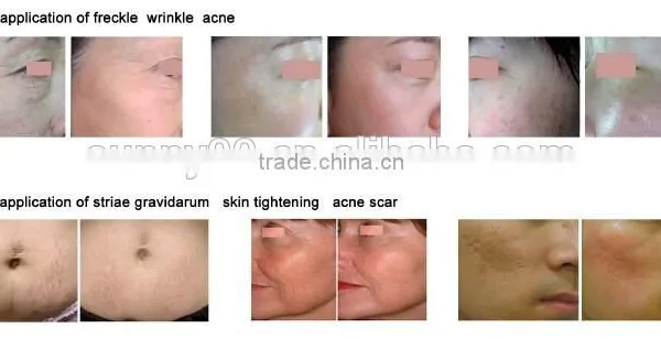 2013 Hot Sale!! Fractional Co2 Laser For Surgical Scar Removal photo-2
