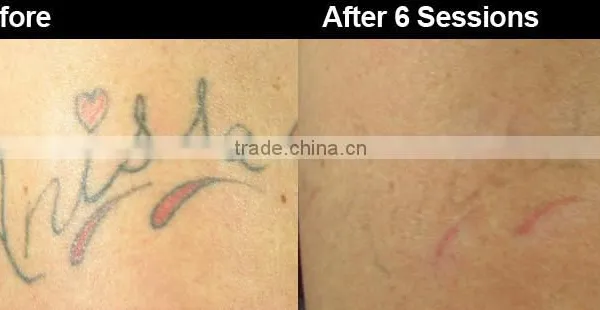 Q Switched Nd Yag Laser Tattoo Removal Machine New Design Tattoo Removal Q Switch Nd Yag Laser 1064nm photo-5