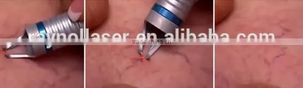 2016 Hot Selling Mini 15W Vasscular Removal Beauty Equipment 980 Laser Spider Machine photo-4