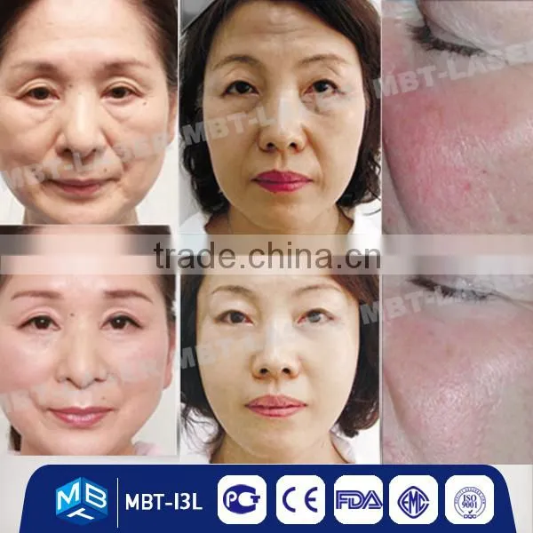 Professional RF Wrinkle Removal Beauty Machine of Radio Frequency Machine for Salon Use photo-4