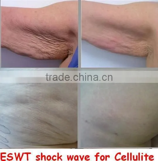 IShock Pro Hot Sale Acoustic Wave Therapy Body Machine Portable photo-5