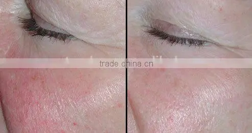 Hot Sale New Year Spider Veins/ Spider Vein Laser/ Spider Vein Removal Machine photo-4