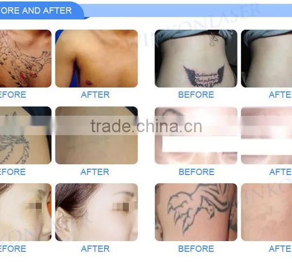 Wholesale Portable Tattoo Removal E-light Ipl Rf+nd Yag Laser Multifunction Machine for Skin Care photo-6