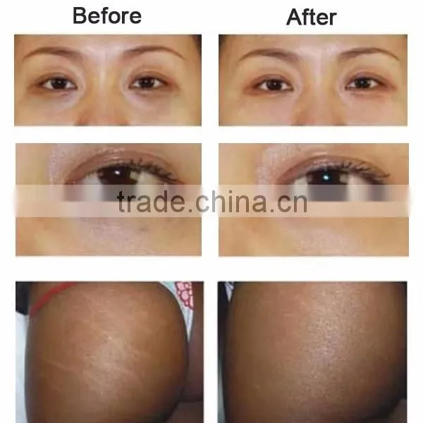CO2 Carboxytherapy Machine , Carboxy Therapy Machine ,carboxtherapy Equipment VM102 photo-3