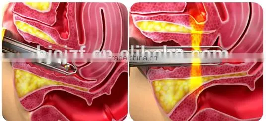 Face Lifting F7+ Fractional Co2 Skin Tightening Laser Equipment Vaginal Fractional Laser photo-6