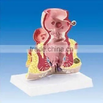 Rectum Common Disease Model
