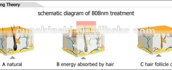 Hot Selling TEC Cooling System Stationary 808nm Diode Laser Hair Removal Depilador Laser Epila photo-4