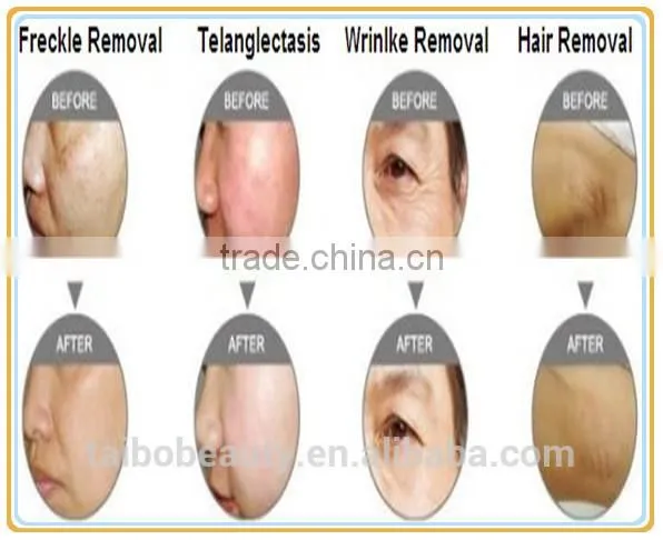 Vascular Treatment 2016 Ipl Shr Hair Removal Machine / Ipl Shr Made In China / Ipl Machine Multifunctional Facial Spa Machine Lips Hair Removal photo-6