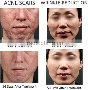 Hot Sale Radiofrequency Fractional RF Microneedle Laser Facial Rejuvenation Machine photo-2