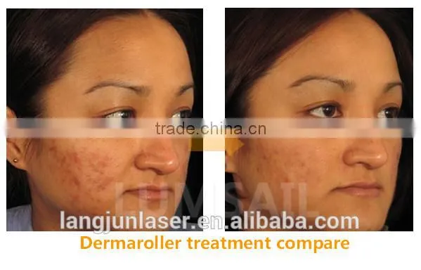 Factory Price 540 Micro Needle Zgts Derma Roller for Skin Therapy photo-4