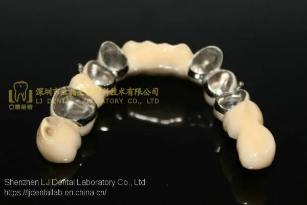 Telesope Crown, Dental Telescope Denture, Dental Prosthesis, Laboratoire Dentaire, Dentallabor, Laboratorio Dental, Dental Laboratory, Shenzhen LJ Dental Lab China