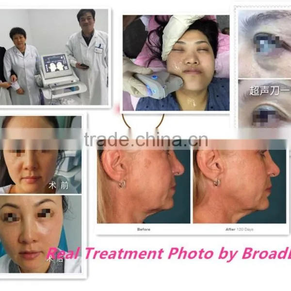 Non-invasive Facial Lifting 13mm for Body Thinner Hifu Vaginal Tighten photo-5