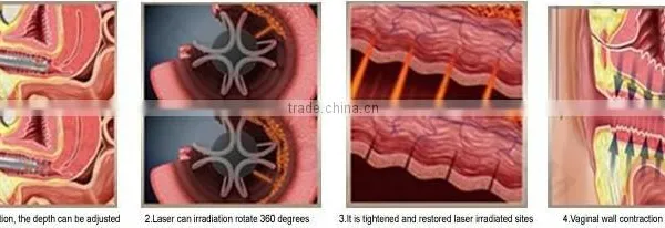 2016 New Product! Portable Hifu Vaginal Tightening/ Hifu Vaginal photo-5