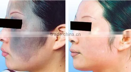 Tattoo Removal Laser Machine ND YAG 2017 Q-Swith Laser Tattoo 0.5HZ Removal Machine For Sale Telangiectasis Treatment photo-6