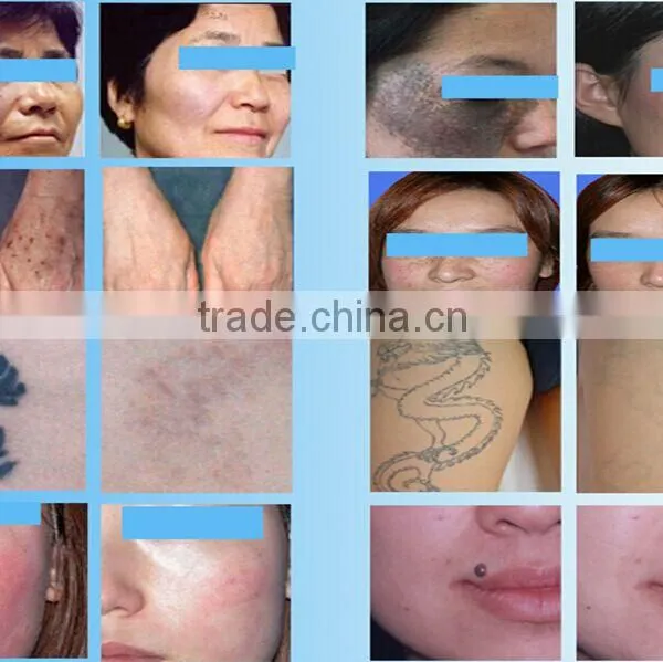 Sanhe SQ-2 Nd: Yag Laser Skin Care System/ 10.4 Inch Color Touch Tattoo Removal Machine photo-5